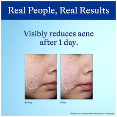 Differin Benzoyl Peroxide Acne Spot Treatment (28g)