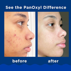 PanOxyl Acne Foaming Wash Benzoyl Peroxide 10% Maximum Strength (156g)