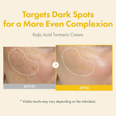 TOSOWOONG Kojic Acid Turmeric Cream for Dark Spots & Hyperpigmentation 50ml