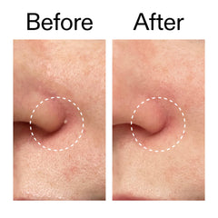The Inkey List Hydrocolloid Invisible Pimple Patches 12 patches