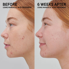 The Inkey List MANDELIC ACID TREATMENT (damaged box)