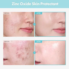 TOSOWOONG Zinc Oxide 10% Cream for Redness & Barrier, Rosacea Treatment 50g