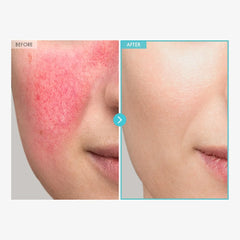 TOSOWOONG Zinc Oxide 10% Cream for Redness & Barrier, Rosacea Treatment 50g