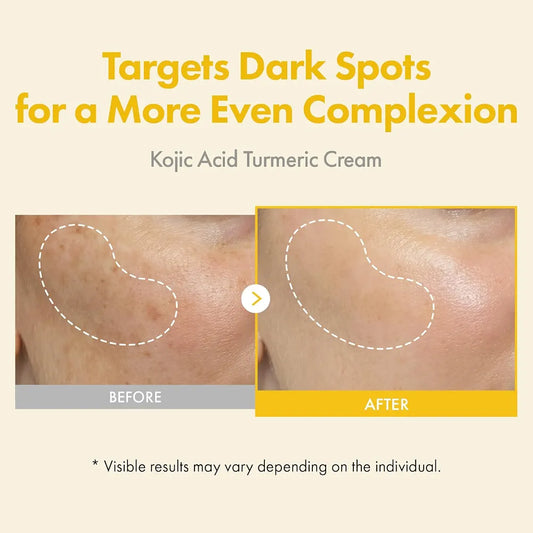 TOSOWOONG Kojic Acid Turmeric Cream for Dark Spots & Hyperpigmentation 50ml