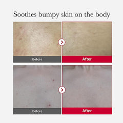 Medicube Red Acne Body Peeling Shot  110g