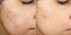 Murad InvisiScar Resurfacing Treatment 30ml